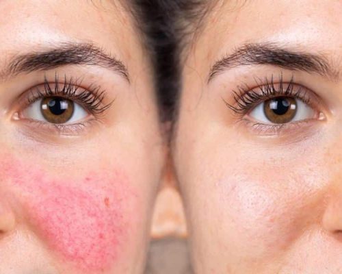 Skincare for Rosacea