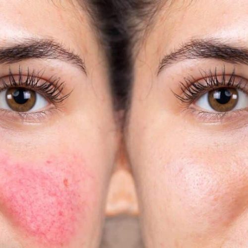 Skincare for Rosacea