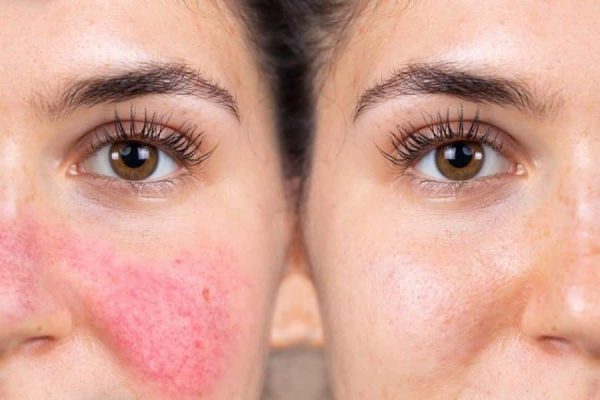Skincare for Rosacea